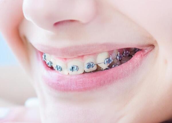 戴了牙套可以用電動牙刷嗎？戴牙套的人群必看！