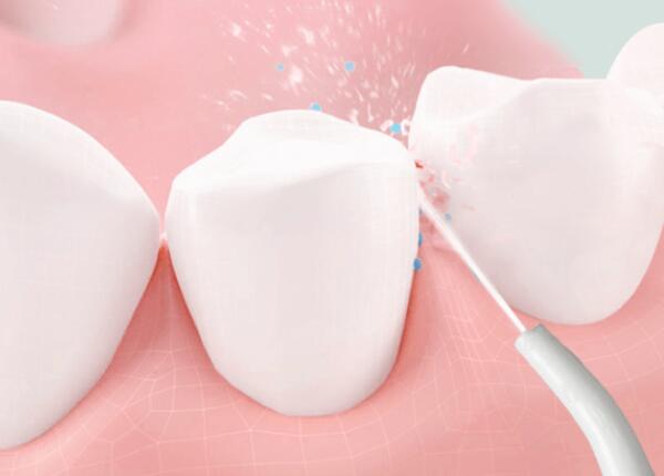 洗牙后用洗牙器好還是電動牙刷？口腔清潔工具這樣選！